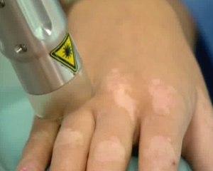 болезнь витилиго фото