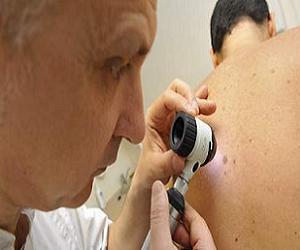 лентиго меланома фото