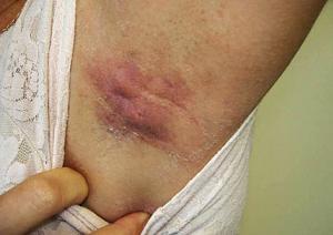 гидраденит под мышкой лечение фото