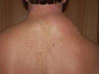 липома что это такое и как лечить