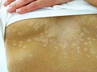 отрубевидный лишай