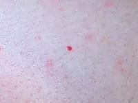 маленькие красные точки на теле