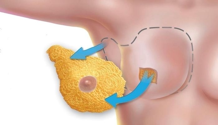 Мастэктомия по Маддену