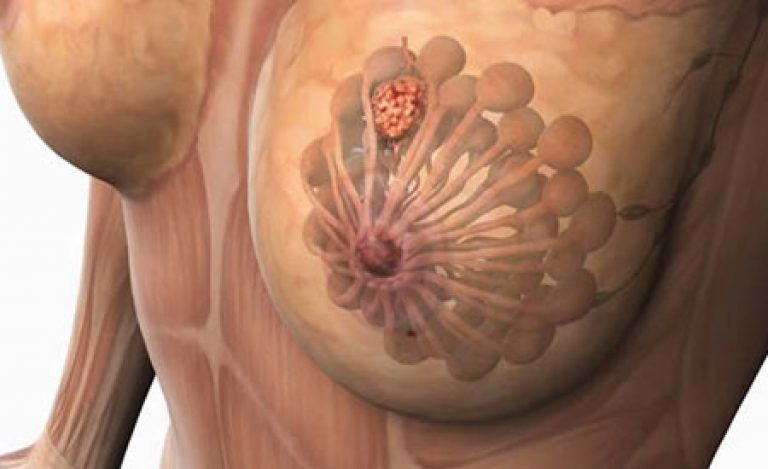 Опухоль в груди Опухоль в груди