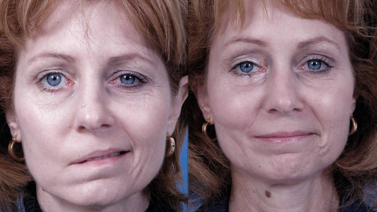 Перекос лицевых мышц