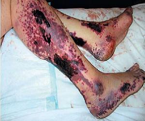 геморрагический васкулит фото