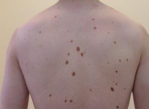 много родинок на теле фото