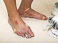натоптыши на пальцах ног