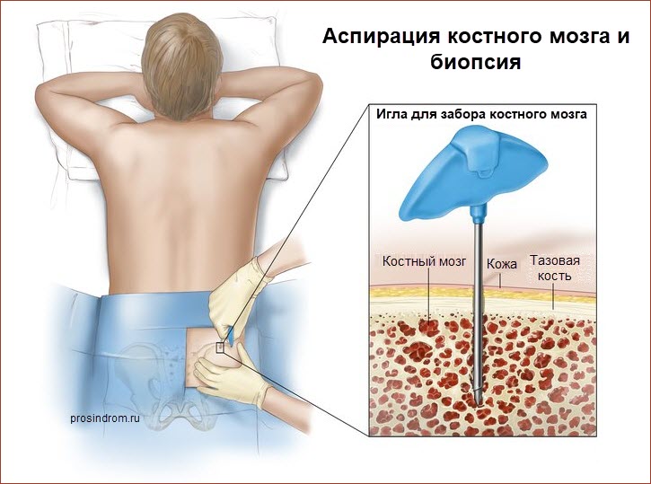 Биопсия костного мозга