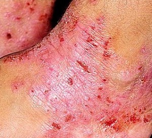 нейродермит симптомы фото