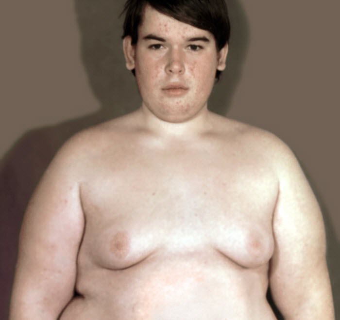 Мальчик с синдромом Фрелиха