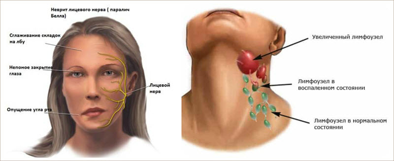Воспаление нервного узла