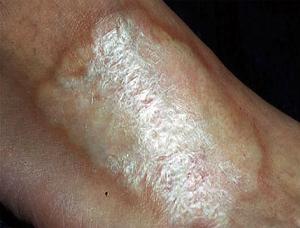 очаговая склеродермия лечение фото