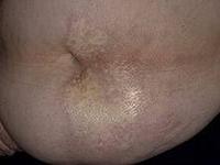 очаговая склеродермия лечение