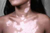 как вылечить витилиго