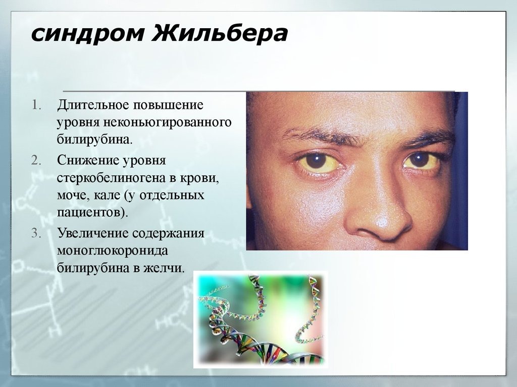 Что такое синдром Жильбера