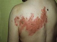 опоясывающий герпес симптомы и лечение