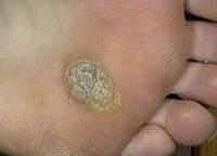 от чего появляются шипицы