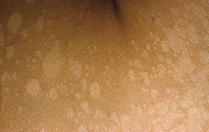 отрубевидный лишай фото