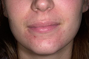 пероральный дерматит на лице фото