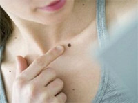 папилломатозный внутридермальный невус кожи