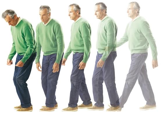 Стадии болезни Паркинсона