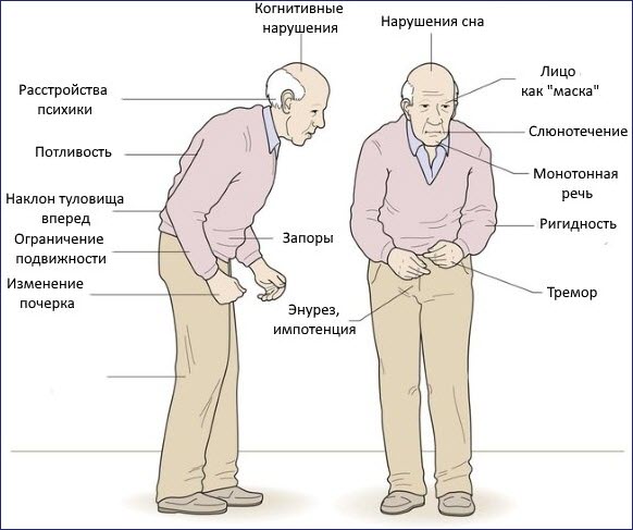 Болезнь Паркинсона