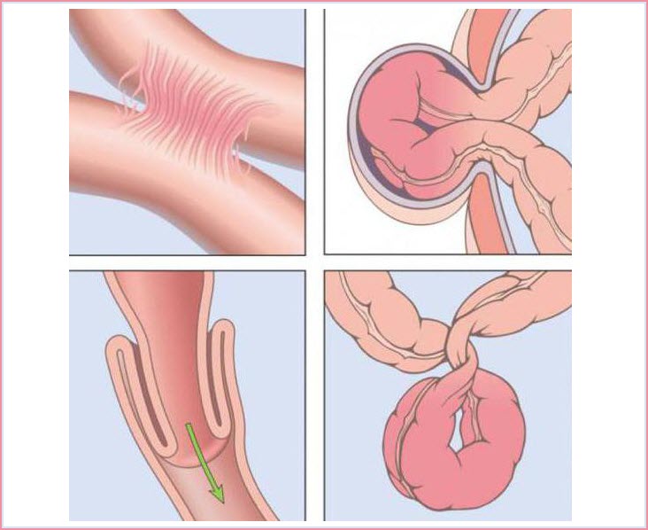 Виды непроходимости кишечника