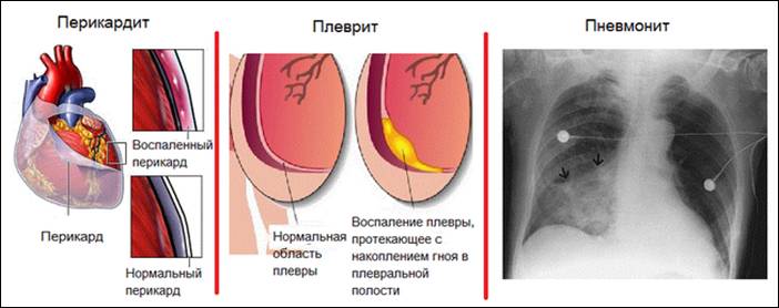 Осложнения при синдроме Дресслера