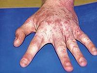 первые признаки чесотки