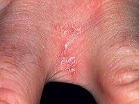 первые признаки чесотки