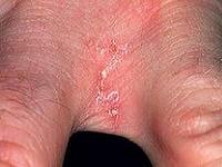 первые признаки чесотки