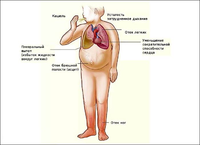 Симтомы сердечной недостаточности
