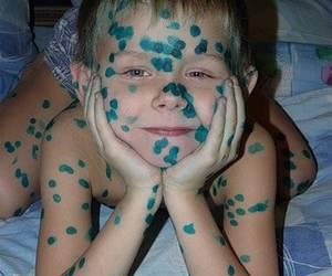 как выглядит ветрянка у детей фото