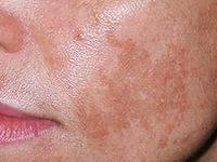 пигментные пятна на теле