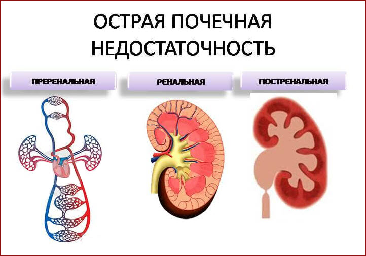 Почечная недостаточность