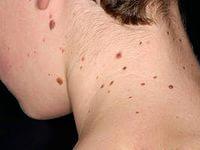 почему появляются родинки на теле