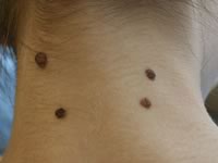 почему появляются родинки на теле