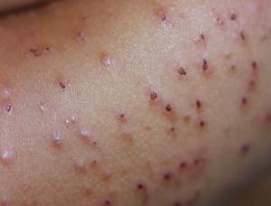 почесуха фото