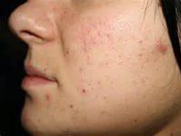 подкожные прыщи на лице