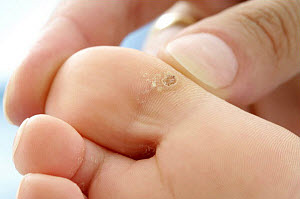 подошвенная бородавка у ребенка фото