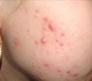 подкожные прыщи фото