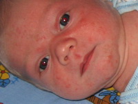 потница у новорожденных как избавиться