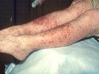 причины геморрагического васкулита у взрослых