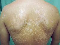 причины и лечение отрубевидного лишая