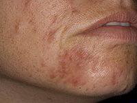 причины появления перорального дерматита