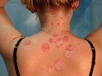 причины появления цветного лишая у человека