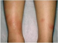 причины появления узловатой эритемы