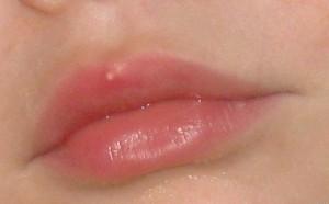 прыщ на губе фото