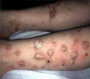 почесуха взрослых фото